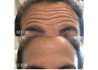 RF Microneedling Near Me